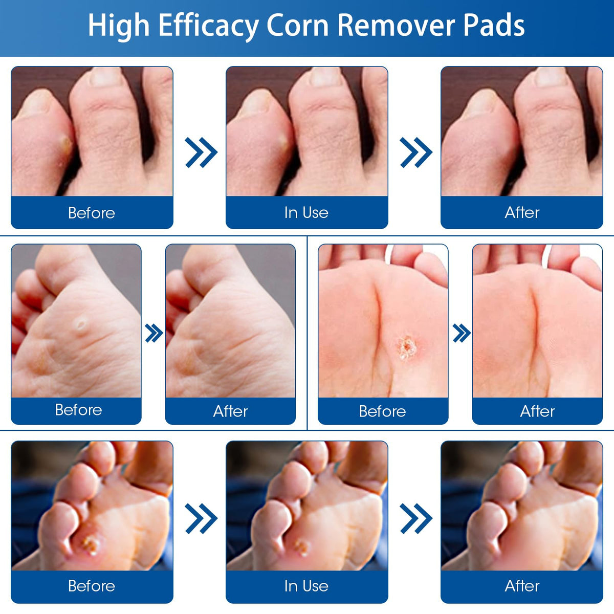 24 Count Corn Removal Pads for Feet and Toe