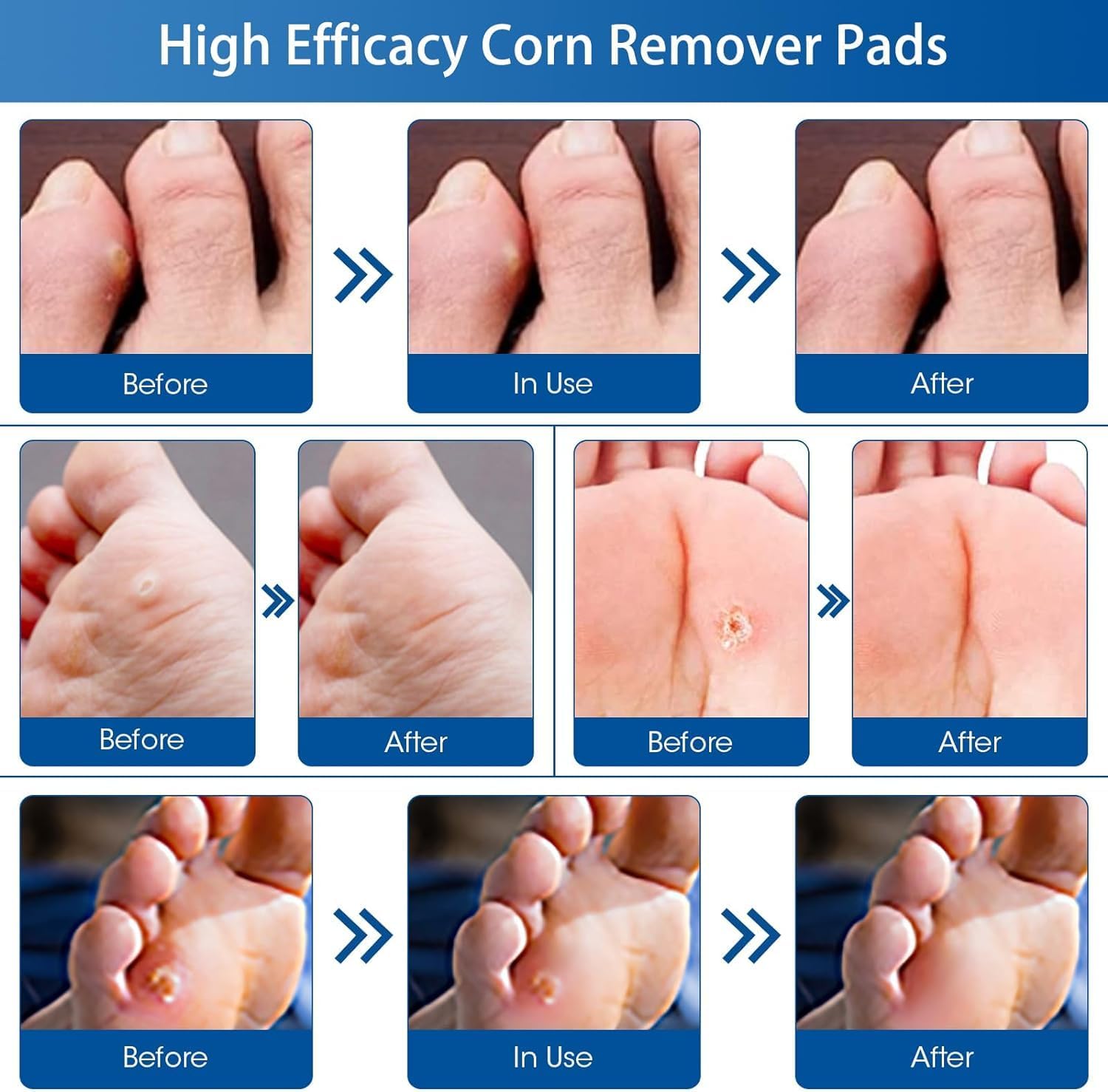48 Count Corn Removal Pads for Feet and Toe