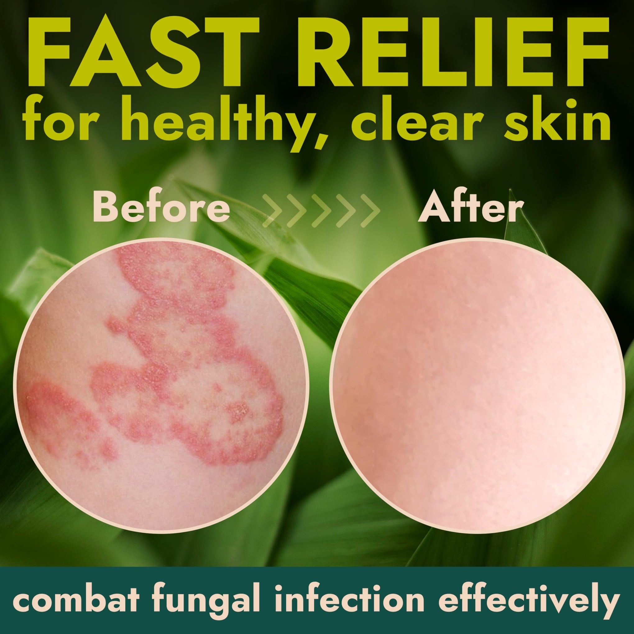 Antifungal Body Cream for Ringworm & Athlete's Foot with Tea Tree Oil (4.05 Fl Oz)