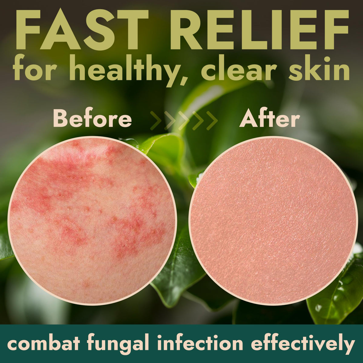 Antifungal Body Spray with Tea Tree Oil for Jock Itch & Athlete's Foot (4.05 Fl Oz)